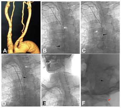 Transradial access with intra-aortic catheter looping for the treatment of intracranial aneurysms